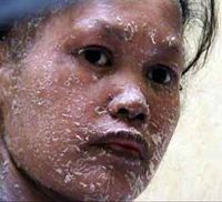 Usai Melahirkan, Kulit Pestaria Bersisik