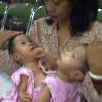 Operasi Tissue Expander Janeeta-Janeetra Diprediksi 5 Jam