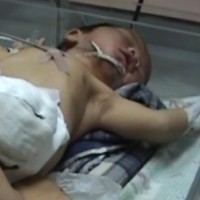 Bayi Kembar Berkepala di Perut Dirujuk ke RSU Adam Malik Medan