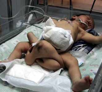 Bayi Kembar Berkepala Diperut