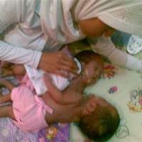 Fadlan dan Fadli Masih Minum Susu Lewat Selang