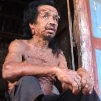 15 Tahun Mulyono Idap Penyakit Kulit Misterius