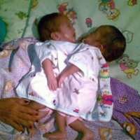 Dada Layat Orang Tua Kembar Siam