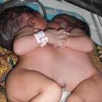 Bayi Kembar Siam Sidoarjo Belum Lolos Fase Kritis