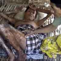 Sekujur Tubuh Keluar Nanah, Toyyib Diisolasi