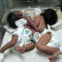 Bayi Kembar Siam Asal Mataram Dirujuk ke RSU Soetomo