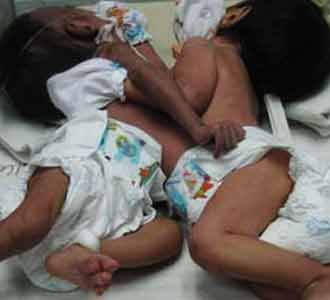 Kembar Siam Asal NTB