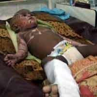 Luka Bakar 35 Persen, Fery Jalani Operasi 10 Jam