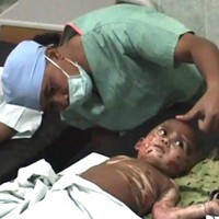 Pascaoperasi, Fery Jalani Terapi Pengeringan Jaringan Kulit