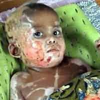 Bantuan untuk  Bocah yang Tersiram Minyak Goreng Mengalir