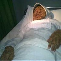 Yani Kembali Akan Dioperasi di RSHS