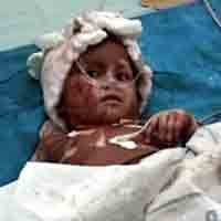 Luka Bakar di Punggung Kering, Fery Minta Duduk