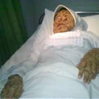 Pasca Operasi Keadaan Yani Stabil