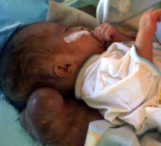 Suryani Terserang Hydrocephalus