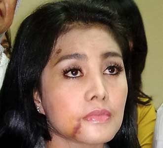 Luka Cici Paramida Masih Membekas