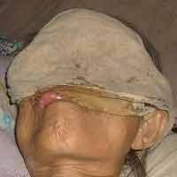 Terserang Kanker Ganas, Wajah Tumini Berlubang