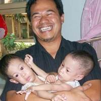 Kembar Janeeta-Janeetra Siap Dipisahkan