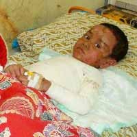 Usai Makan Tongkol, Sekujur Tubuh Bocah SD Melepuh