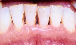 Abses Periodontal