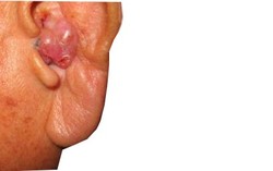 Tumor Telinga