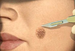 Tahi Lalat Tanda Kanker Kulit?