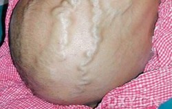 Sindroma Budd-Chiari