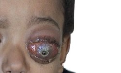 Retinoblastoma