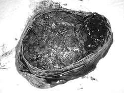 Solusio Plasentae