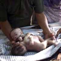 Tim Dokter Masih Rawat 2 Pasang Kembar Siam