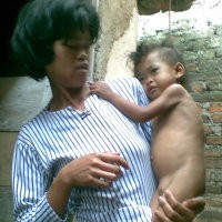 Gizi Buruk Turunkan IQ Anak