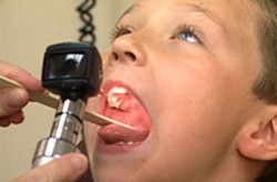 Amandel (Tonsilitis)