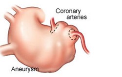 Aneurisma Aorta Torakalis 