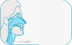 Laringitis Tuberkulosis