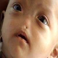 Zahra Terlahir dengan Hidung Tak Bertulang & Berlubang Satu