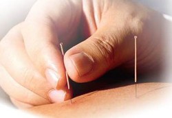 Akupuntur Kurangi Kelebihan Hormon Testosteron Perempuan 