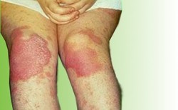 Psoriasis