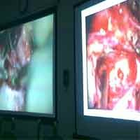 Operasi Pemasangan Implan Pada Koklea Pertama di Surabaya