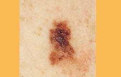 Melanoma