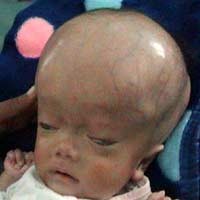 Bocah 4 Bulan Terserang Hydrocepalus