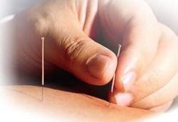 Bagaimana Cara Kerja Akupuntur? 