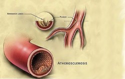 Atherosclerosis