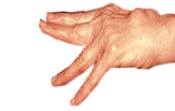 Rheumatoid Arthritis