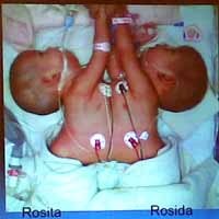 Dokter Waspadai Infeksi & Pendarahan Rosida-Rosita