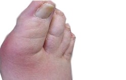 Gout