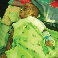 Diduga Alergi Obat, Sekujur Tubuh Rizki Melepuh