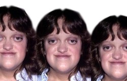 Ablepharon-Macrostomia Syndrome (AMS)