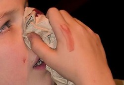 Anak Kecil Kok Sering Mimisan