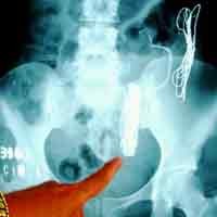 Sepekan Dirawat di RS, Cicin Meninggal Dunia