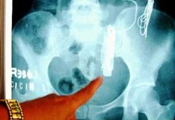 Perut Isi Kawat dan Logam, Pasien Gagal Diselamatkan 