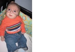 Vonis Mati Bayi Trisomi 18